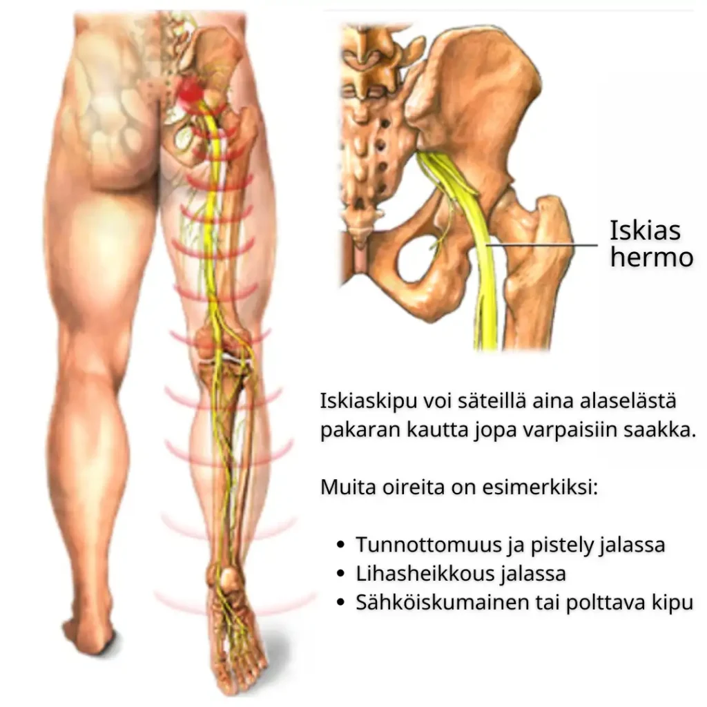 Iskiaksen oireet.